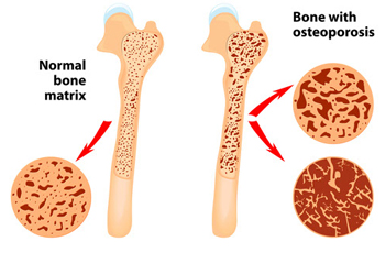 Bone Profiles